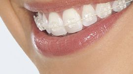 יישור שיניים INVISALIGN
