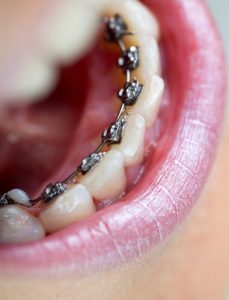 inside-teeth-straightening