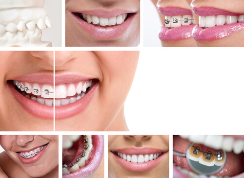 שיניים עקומות – כל הסיבות והפתרונות